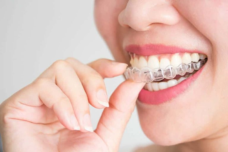 Invisible aligners