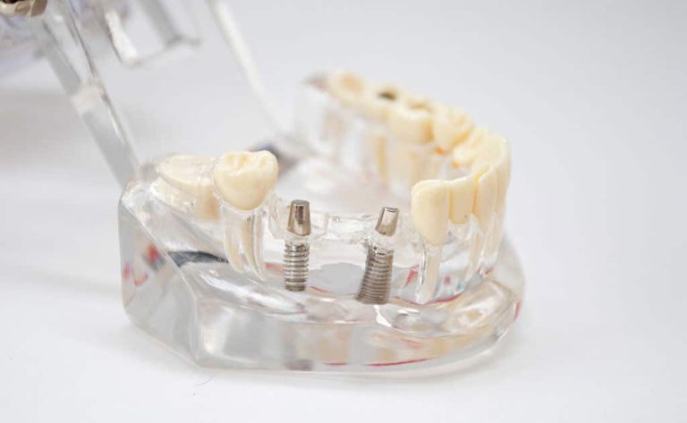Immediate Implants – the evolution of Immediate Loading