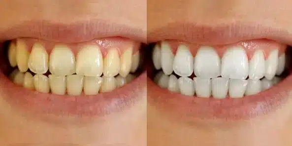 Yellow teeth and tobacco