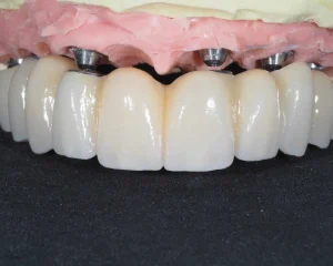 dental implant, What is oral rehabilitation?