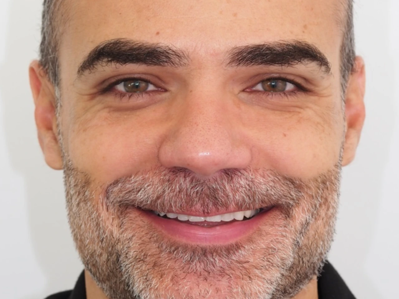Estado inicial antes das facetas