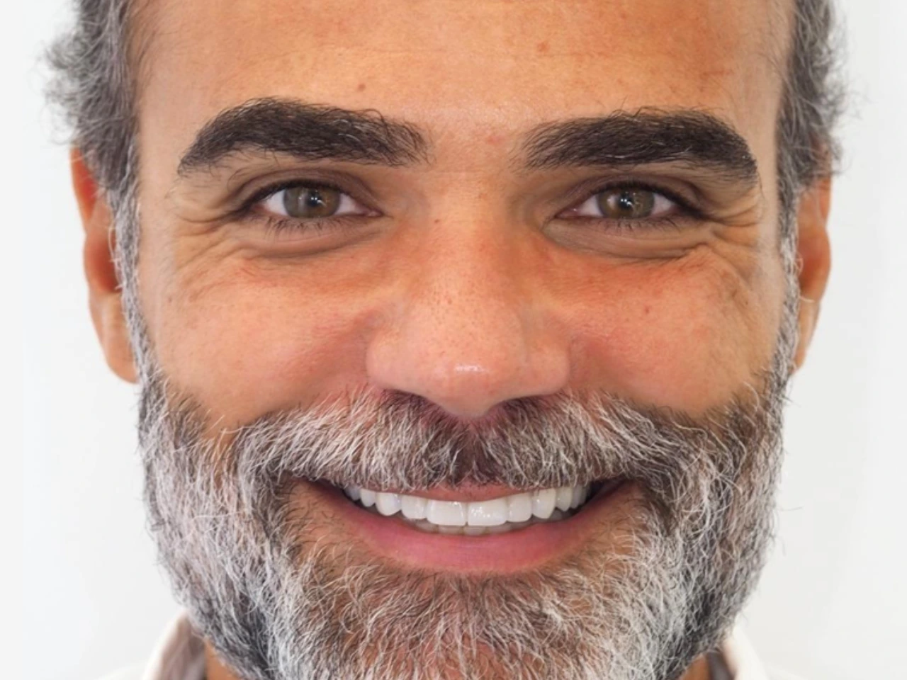 Resultado final de facetas dentárias