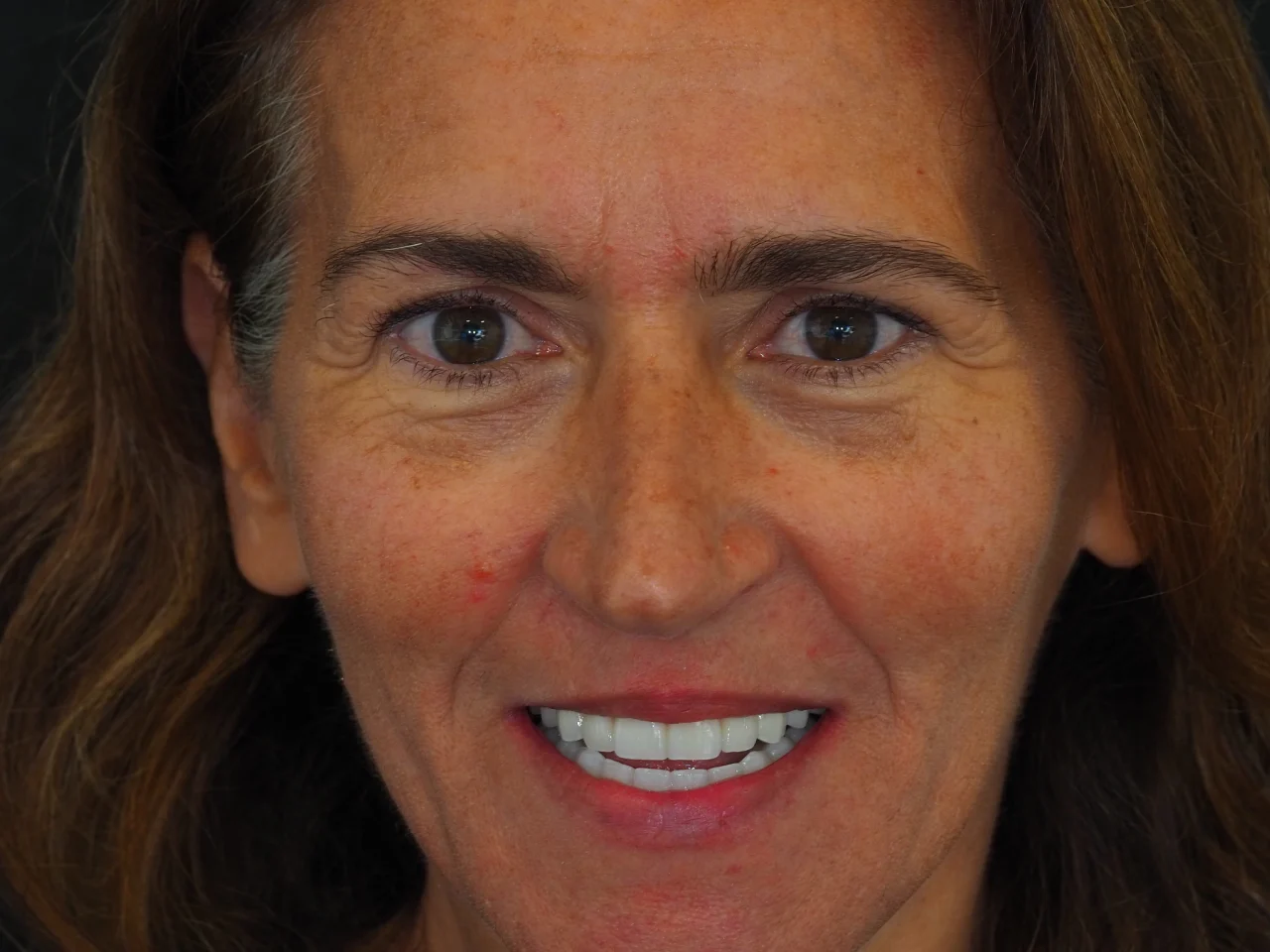 Resultado final de implantes dentários