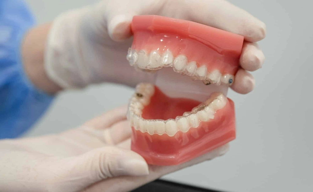 Invisalign Alinhadores Transparentes